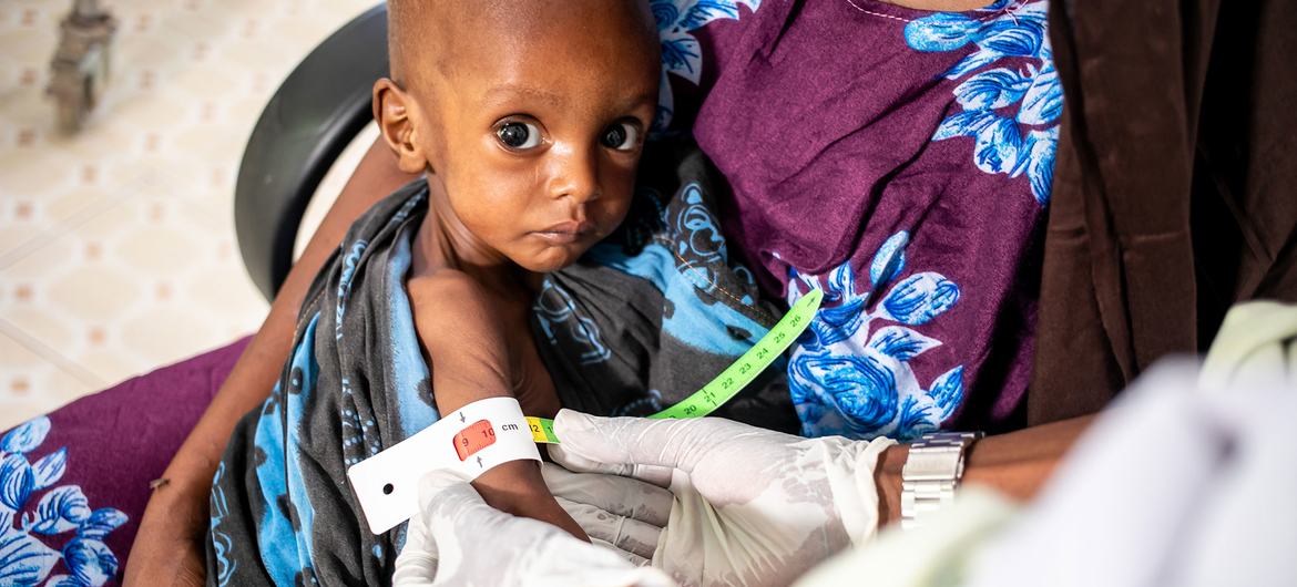 Este niño de un año gravemente desnutrido está recibiendo atención en un hospital en Dolow, Etiopía.