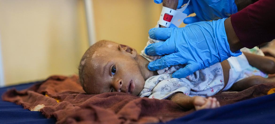 Un médico mide la circunferencia del brazo de Ibrahim, un niño de ocho meses que sufre de desnutrición, en un hospital de Mogadishu, Somalia.