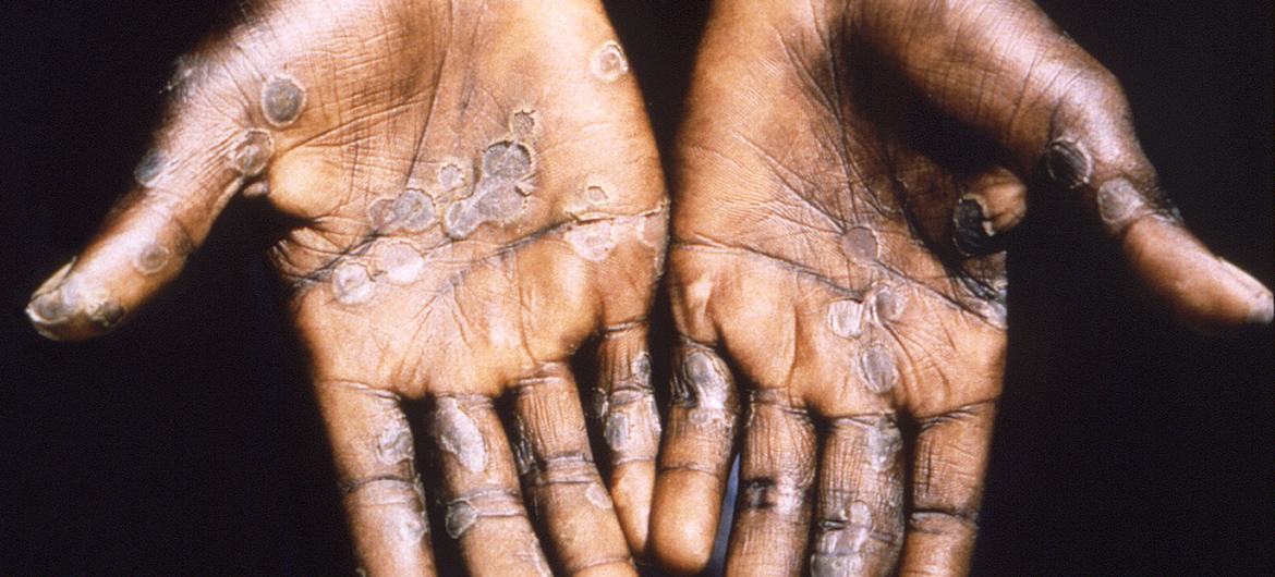 Las lesiones de viruela del mono suelen aparecer en las palmas de las manos.