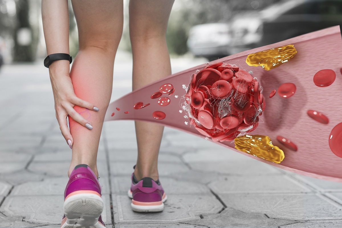 La aparición de dolor al caminar, aunque sea de unos pocos metros, es el síntoma más común.